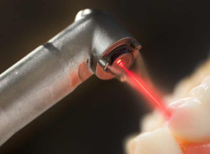 laser dental cavity